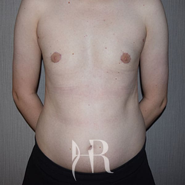 HR Plastic Surgery - Male Breast Reduction patient after 1